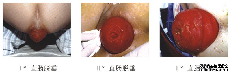 治疗脱肛最好的方法是什么？