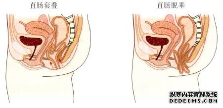 脱肛会是哪些疾病