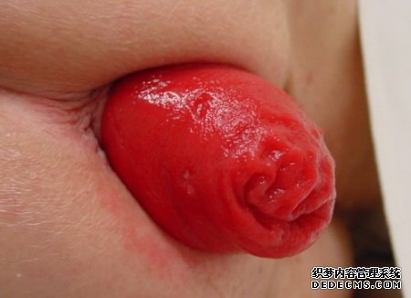 脱肛有哪些危害呢?