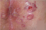 肛门湿疹和肛周脓肿有哪些不同
