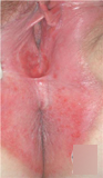 肛门湿疹的症状有哪些？