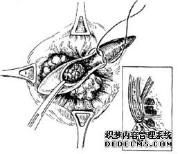 得了便血不治会有什么样的后果