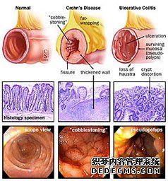 哪些原因导致结肠炎？