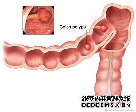 为什么会得直肠炎？