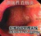 怎么判断得了直肠炎